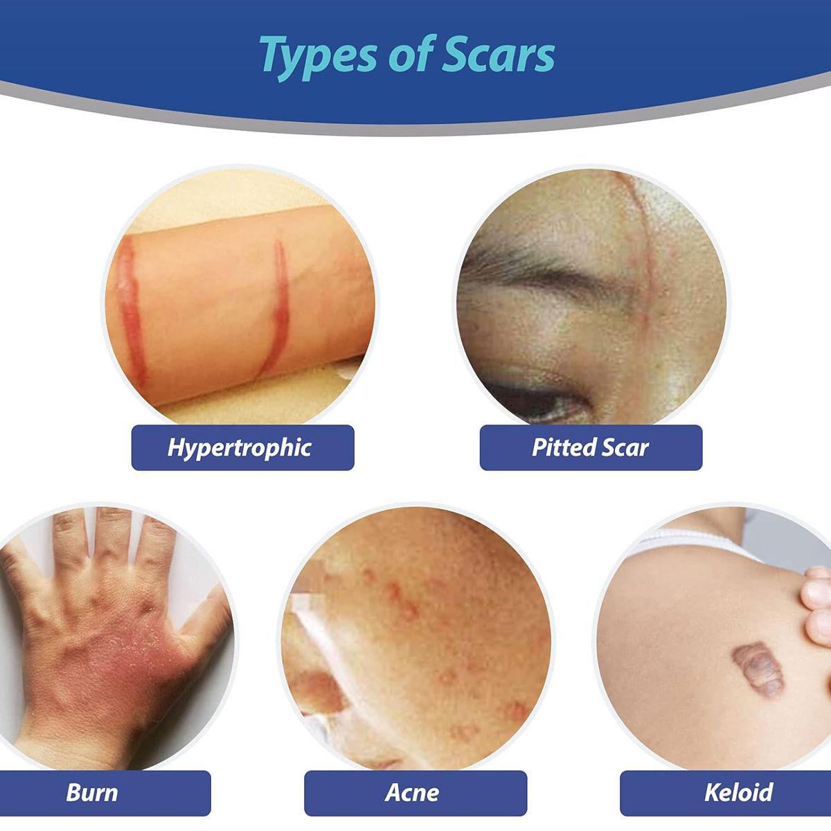 scarmin gel tube for different types of scars